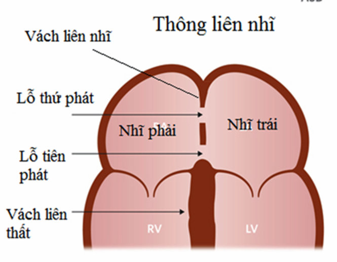 Thông liên nhĩ - Hình ảnh minh họa